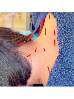 アオヤマ サロン ワイゼット(AOYAMA SALON YZ)/首肩こりには鍼が効きます