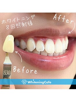 ホワイトニングカフェ 苫小牧店(WhiteningCafe)/ ◎歯のホワイトニング施術写真