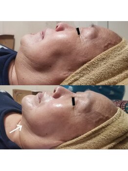 小顔アンドエイジングケア専門店 ビゼ(美sser)/REVIハーブピーリング