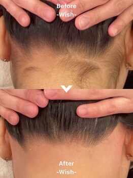 ウィッシュ 与野(Wish)/襟足 うなじ脱毛