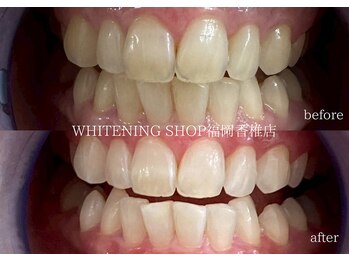 ホワイトニングショップ 福岡香椎店/美容ホワイトニングbefore after
