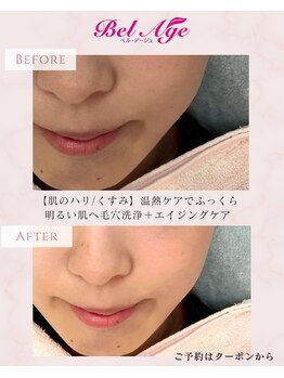ベル アージュ/毛穴洗浄フェイシャル