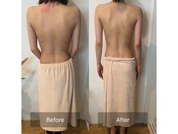 サロンツキ(salon tuki)/【背中ハーブ】症例