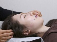 めい鍼灸院/お顔の施術