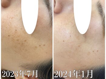 ニコ アンド キャンディー(Nico.&Candy)/本気でシミ改善したい方募集中