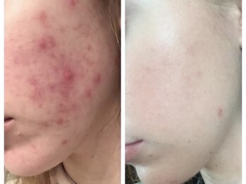 グッドスリープ(Good sleep)/KMP 韓国式ピーリング 池袋