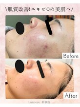 ルミエル 泉店(Lumiere)/ハーブピーリング