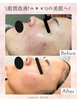 ルミエル 泉店(Lumiere)/ハーブピーリング