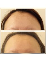 イーオ(io)/おでこのシミが薄く！