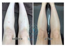 サロンアメリ 高松丸亀町店(Salon Ameri)/香川　高松　全身脱毛　アメリ