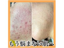 プラズマ、韓国ピール、ハーブ、WAX等それぞれのお悩み改善へ