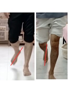 ナカザワ(NAKAZAWA)/母趾症状・巻き爪になる歩き方