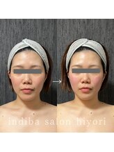 ヒヨリ(hiyori)/《before/after》フェイシャル