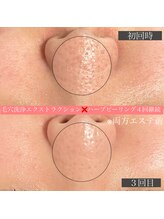 エミーニー(emiiny)/ハーブピーリングで毛穴レス肌！