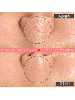 エミーニー(emiiny)/ハーブピーリングで毛穴レス肌!