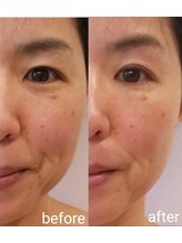 リッチ(Riche)/お任せ美顔初回、小顔＆美肌