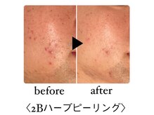 サロンドシェリ(salon de cheri)/ハーブピーリング