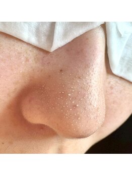 シュナ(syuna)の写真/【毛穴エクストラクションプロ導入店】なかなか改善されない毛穴の黒ずみ・いちご鼻にアプローチ★