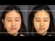 ユウキシキ(YUKISIKI)/YUKISIKI小顔矯正&美容鍼