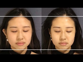 ユウキシキ(YUKISIKI)/YUKISIKI小顔矯正&美容鍼