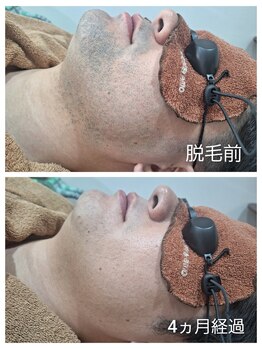 アカラ 読谷店(AKALA)/ヒゲ脱毛4ヶ月経過