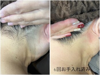 レイズ(RAISE)/うなじ脱毛　経過写真
