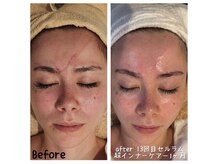 自然治癒力アップ♪人気no.1ファイシャルコース/セルラム◎