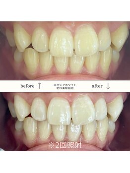 エクシアホワイト 平岸駅前店/ホワイトニングビフォーアフター