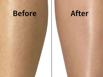 モンロー(MonroE+)/脱毛