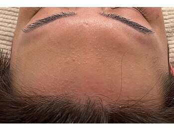 モネ(monet)/ポツポツできやすい方も