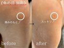 魚の目ケア 1/1
