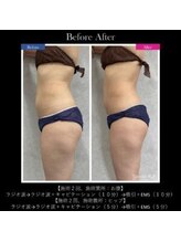 ヴェリー(VARY)/痩身ビフォーアフター