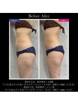 ヴェリー(VARY)/痩身ビフォーアフター