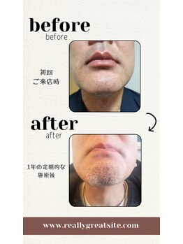 ユメバンチ(yumebanchi)/ヒゲ脱毛