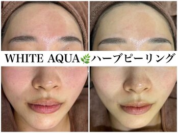 ホワイトアクア 広島店(WHITE AQUA)/ハーブピーリング/赤ら顔