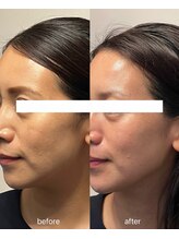 ルミライ(Lumirai)/二重顎なくなりスッキリきれい！