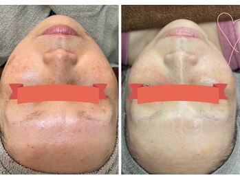 シーカラー 中野栄店(C.color)/シミケア