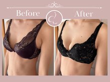 美バストアルファ(美bust α)/【バストアップ】症例