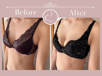 美バストアルファ(美bust α)/【バストアップ】症例