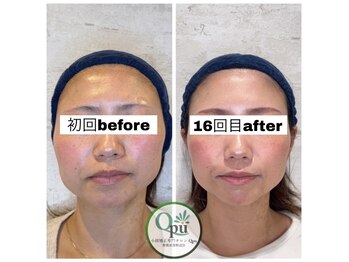 キュープ 相模原淵野辺店(Qpu)/たった4回で人生で1番小さな顔に