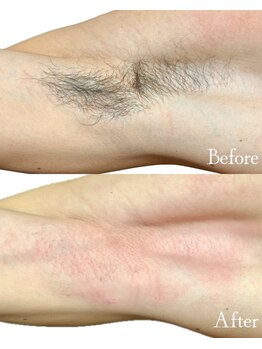 ロイヤルキューティー 介正鍼灸整骨院 コマーシャルモール博多(ROYAL QT)/脇WAX脱毛