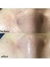 フルーヴ ルフレ(Fleuve Reflet)/人気メニュー♪毛穴徹底ケア！