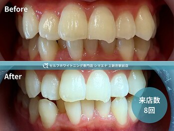 シマエナ 上新庄駅前店の写真/清潔感のある白い歯が、できる男の印象を変える。上新庄のメンズホワイトニング。