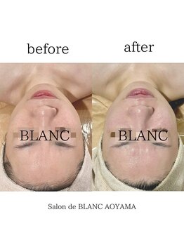 サロン ド ブラン アオヤマ(Salon de BLANC AOYAMA)/ハリツヤアップ