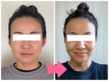 小顔矯正サロン ブルーム/立体的なお顔に