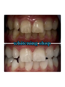 ホワイトニングショップ 大阪玉造店/Before&After美白ホワイトニング