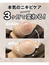 ビレボ マエバシ(BEREVO maebashi)/Before After