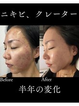 リヴィア(LIVIA)/ニキビ・凸凹も綺麗に