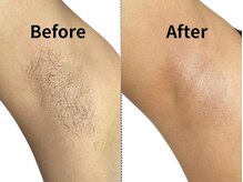 モンロー(MonroE+)/脱毛