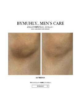 モア(more.)/ひざの変化(1回)